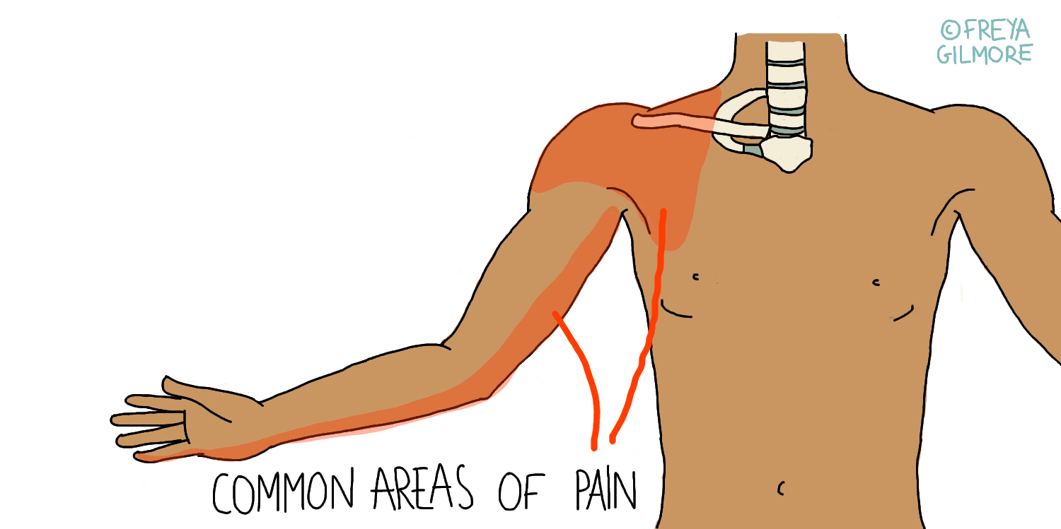 Understanding Thoracic Outlet Syndrome